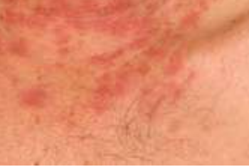 Dermatites
